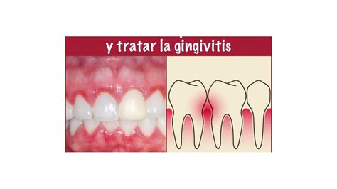 4 Remedios Naturales Para Combatir La GINGIVITIS