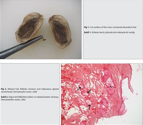 Figure 1 From Dermoid Cyst Penetrating The Abdominal Cavity In A