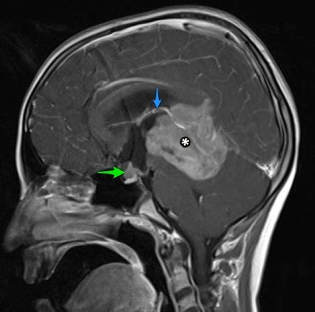 Pineoblastoma | Image | Radiopaedia.org