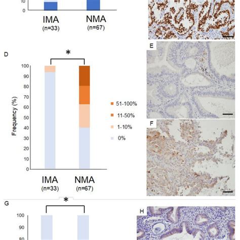 Immunostaining For Thyroid Transcription Factor 1 TTF 1 And Immune