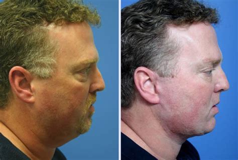 3 D Volumetric Facelift Archives Anthony Youn MD FACS