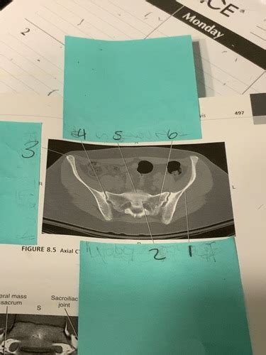 Ct Pelvis Flashcards Quizlet