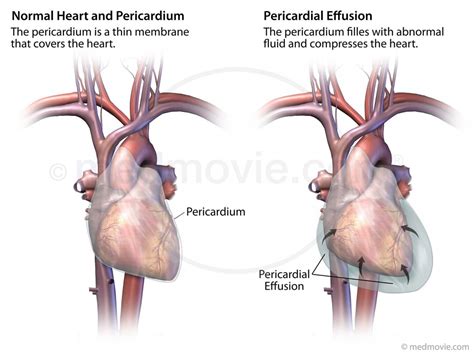 Pericardial Effusion – Medmovie.com