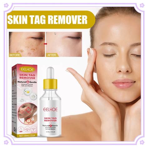 Skin Tag Remover Cream Genital Warts Treatment Dark Spots Freckle Moles