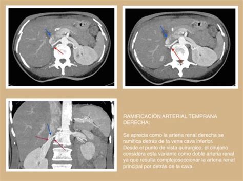 Figure From Evaluaci N Mediante Tcmd De La Anatom A Renal Y Vascular