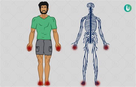 Peripheral Neuropathy Symptoms Causes Treatment Medicine Prevention Diagnosis