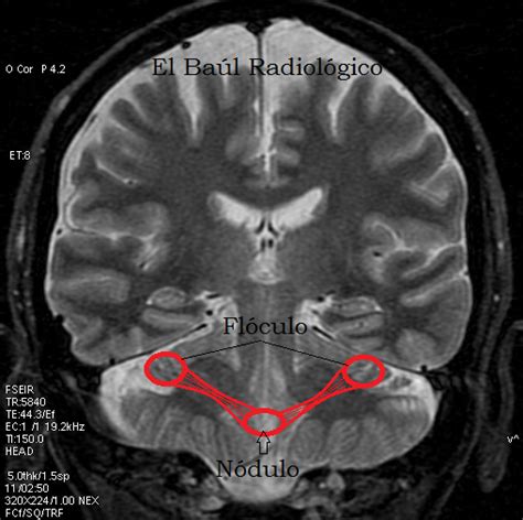 El Baúl Radiológico LÓbulo Floculonodular Cerebeloso The Cerebellar