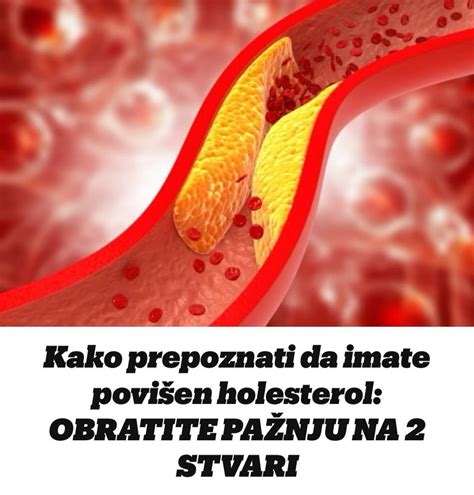 Kako prepoznati da imate povišen holesterol OBRATITE PAŽNJU NA 2