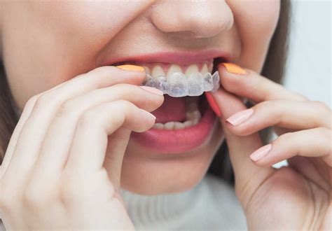 Invisalign A Skutki Uboczne Czy Jakie Istniej