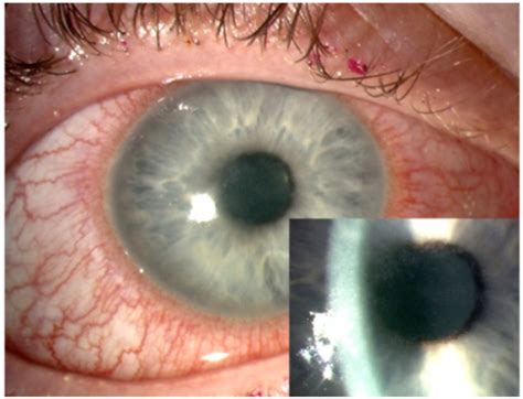 Early Acanthamoeba Keratitis