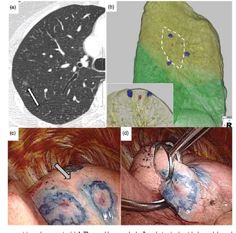 Figure 2 From Thoracoscopic Wedge Lung Resection Using Virtual Assisted