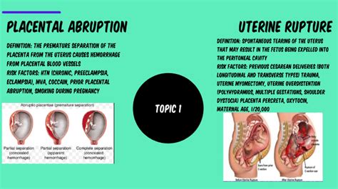 Placental Abruption And Uterine Rupture By Colby Mcwhorter On Prezi