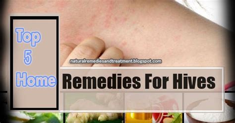 Top 5 Home Remedies for Hives - Natural Remedies And Treatment