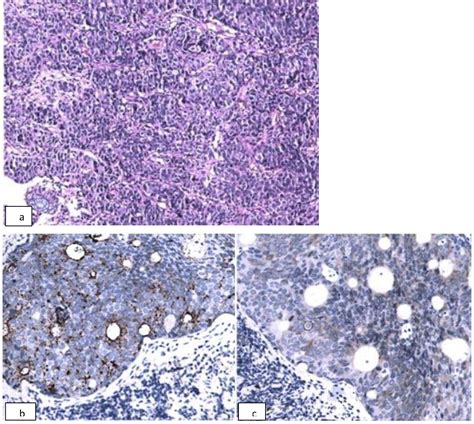 Incidental Detection Of Neuroendocrine Carcinoma Of Rectum During