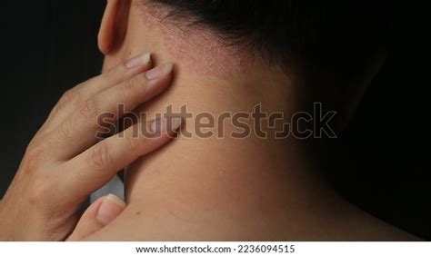 Psoriasis Skin Disease Causes Rash Itchy Stock Photo 2236094515 ...