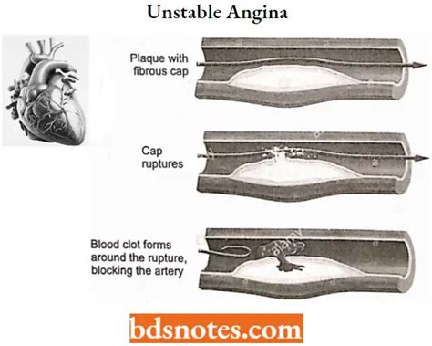 Antianginal Drugs Classification - BDS Notes