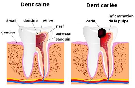 La Carie Dentaire Clinique Dentaire Dr Barbry