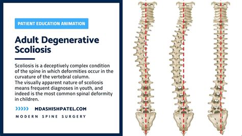 Adult Degenerative Scoliosis — Patient Animation - Ashish Patel, MD