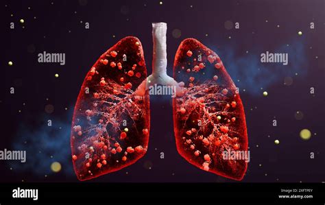 Doctors Hand Infected Lungs Concept Tuberculosis Mycobacterium