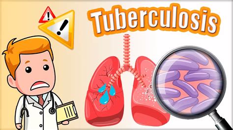 Tuberculosis Tb S Ntomas Diagn Stico Mantoux Y Tratamiento