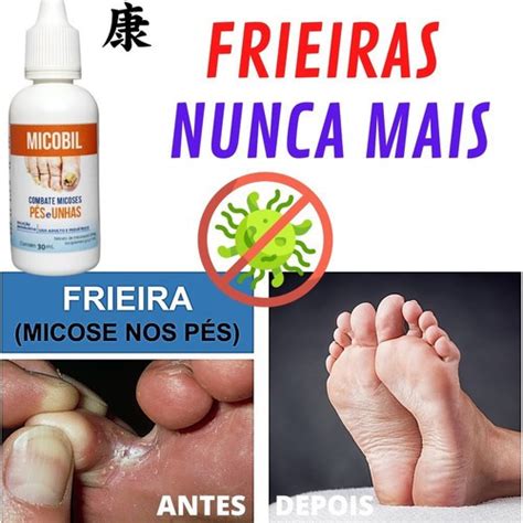 Mata Frieira Nos Dedos Mata Micose Na Pele Mata Micoze P