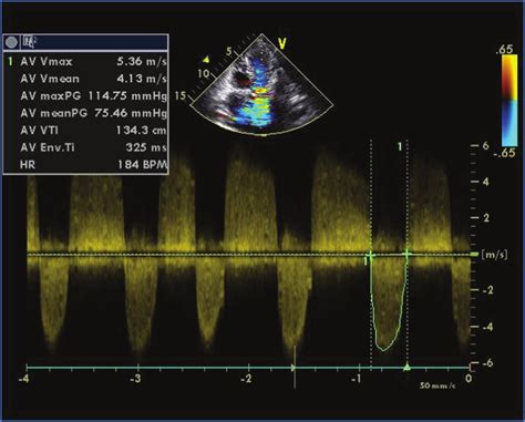 Echocardiogram Aortic Stenosis