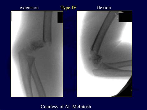 Fractures And Dislocations About The Elbow In The Pediatric Patient