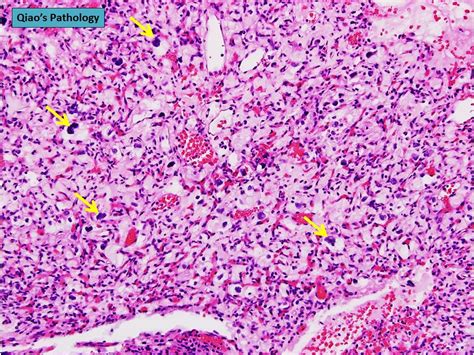 Hemangioblastoma Foamy Cells