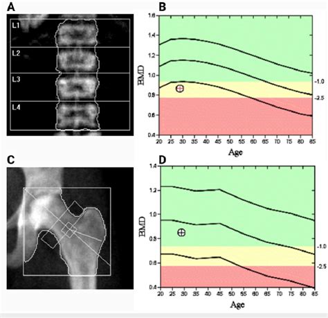 Dual-energy X-ray absorptiometry (DEXA) scan of the lumbar spine (A)... | Download Scientific ...