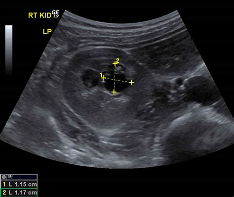 Renal Medulla Ultrasound