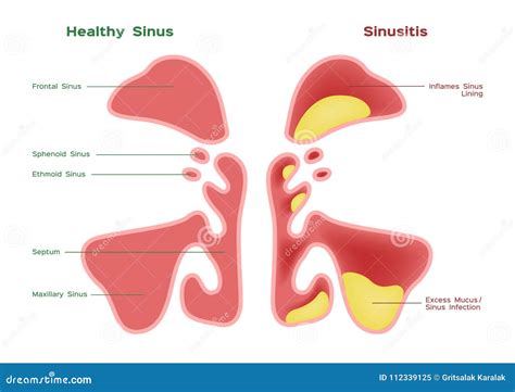 Seno Nasale Vettore Di Infiammazione E Sano Del Seno Illustrazione