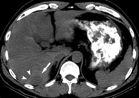 Hepatic Hemangiomas With Arterioportal Shunt Sonographic Appearances With Ct And Mri