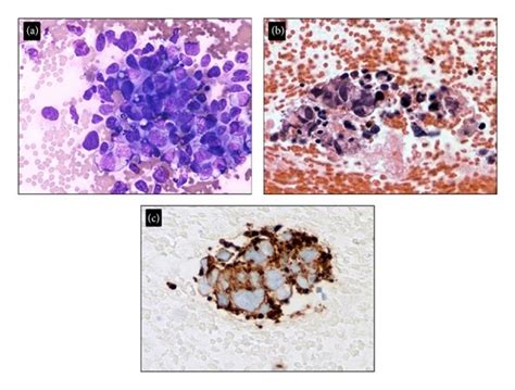 Parotid Tumor Pathology Smear And Cell Block Section From Fna Biopsy