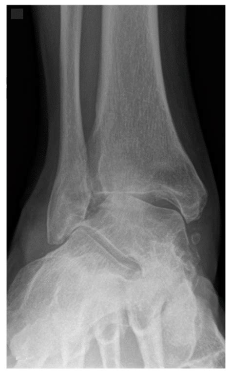 Does Concurrent Distal Tibiofibular Joint Arthrodesis Affect The