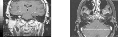 Resonancia Magn Tica Cerebral Que Evidencia La Presencia De Un