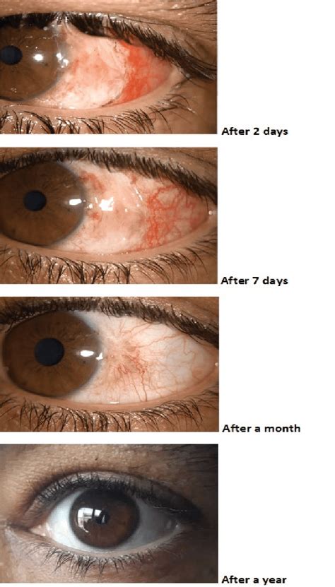 Patient conjunctival nevus 2 days, a week, a month, and a year after ...