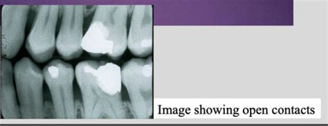 Intraoral Techniques 1 Flashcards Quizlet