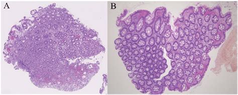 Histological Findings Of Colonic Biopsy Samples Stained With Download Scientific Diagram