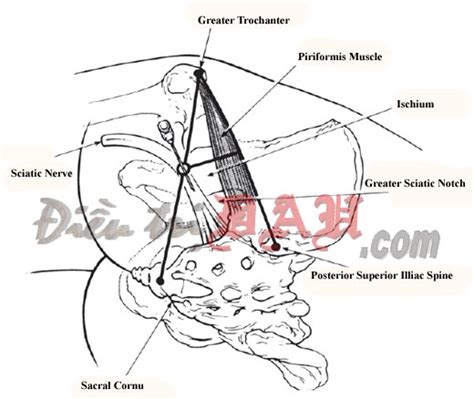 Sciatic Nerve Block - Pain Management