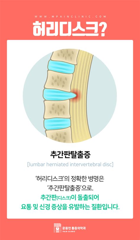 허리통증과 허리디스크 초기증상