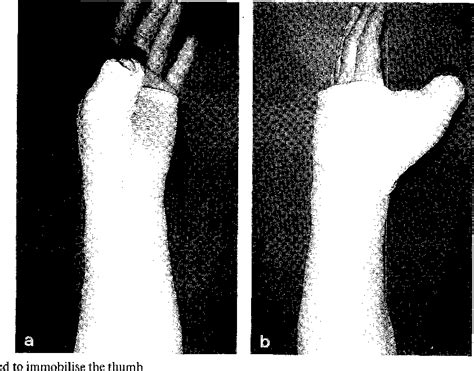 Figure 1 from Flexor Pollicis Longus Tendon Repair: A Comparison ...