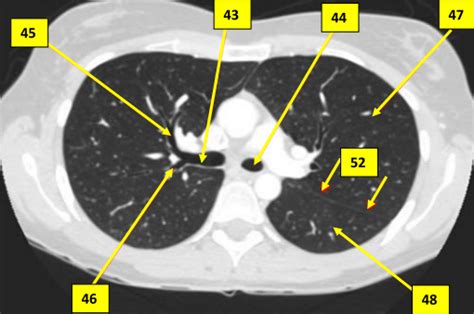 Schaubild Schnittbildanatomie Thorax Lobus TRA Quizlet