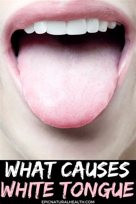 What Causes White Tongue | HOW TO GET RID OF WHITE TONGUE QUICKLY ...