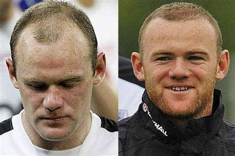 Wayne Rooney Trapianto Capelli In Italia