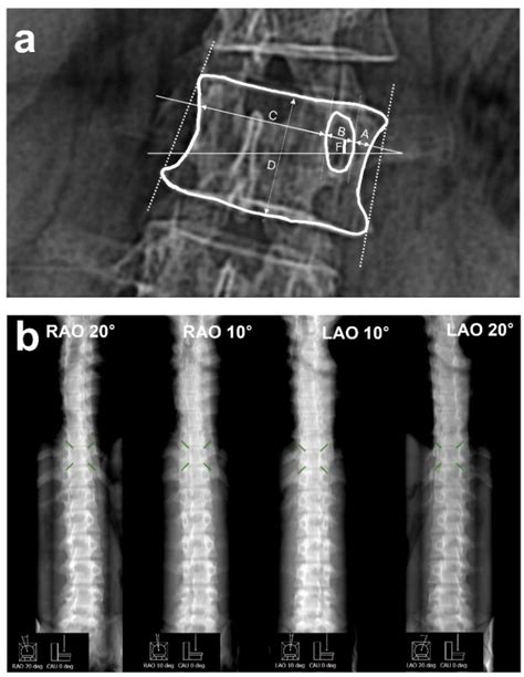 Developing a Spine Internal Rotation Angle Measurement System Based