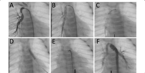 Stenting Of Double Patent Ductus Arteriosus Pda In A Patient With Download Scientific Diagram