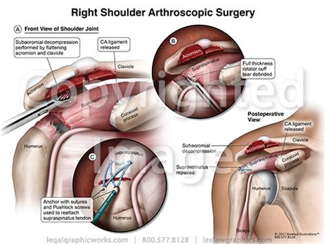 Shoulder Arthroscopic Surgery_2 - Legal Graphicworks