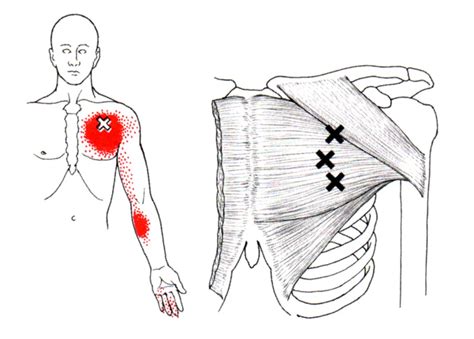 Hurne Chiropractic Pectoralis Major And Minor