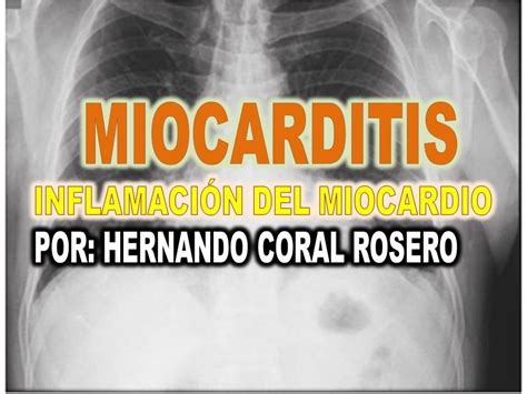 Miocarditis Causas Sintomas Y Secuelas Causas Electrocardiograma