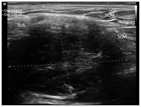 Unusual Clinical Presentation Of Cervical Extradural Meningioma